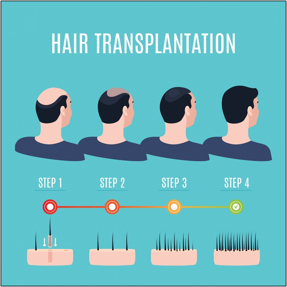 Say Goodbye to Discomfort: The Benefits of Painless Hair Transplant