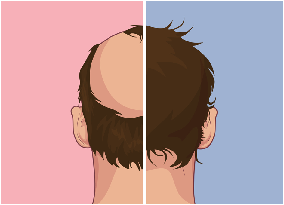 Everything You Need to Know About Maintaining Your Hair Patch